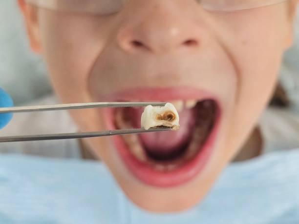Best Emergency Broken Tooth Repair in Gonzales, CA